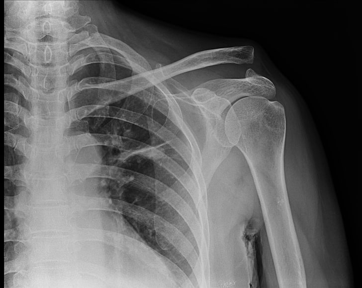 closeup photo of a negative x-ray result, medicine, separated shoulder